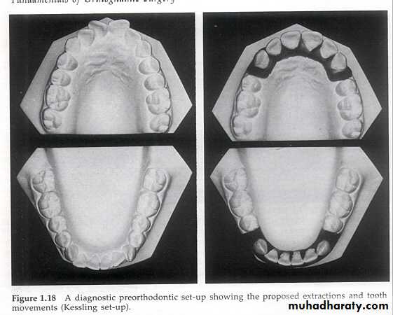 orthognathic surgery