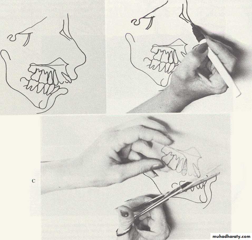 orthognathic surgery
