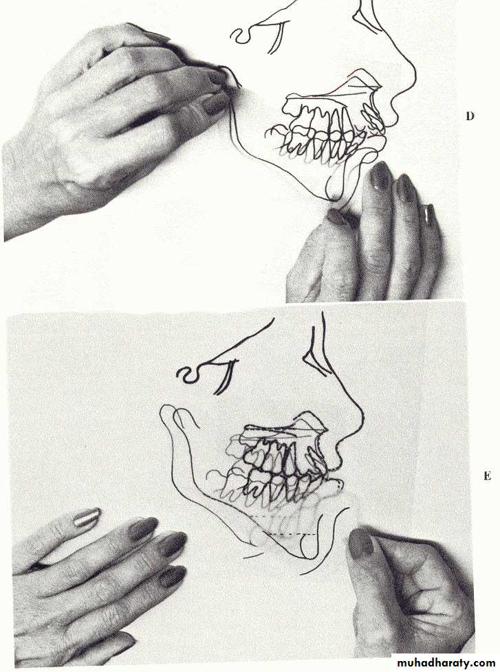 orthognathic surgery