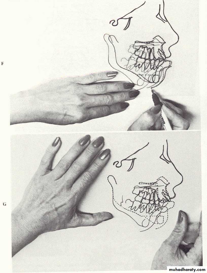 orthognathic surgery