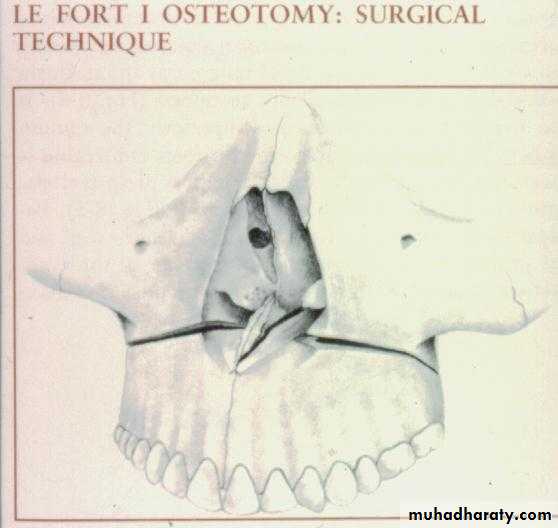 orthognathic surgery