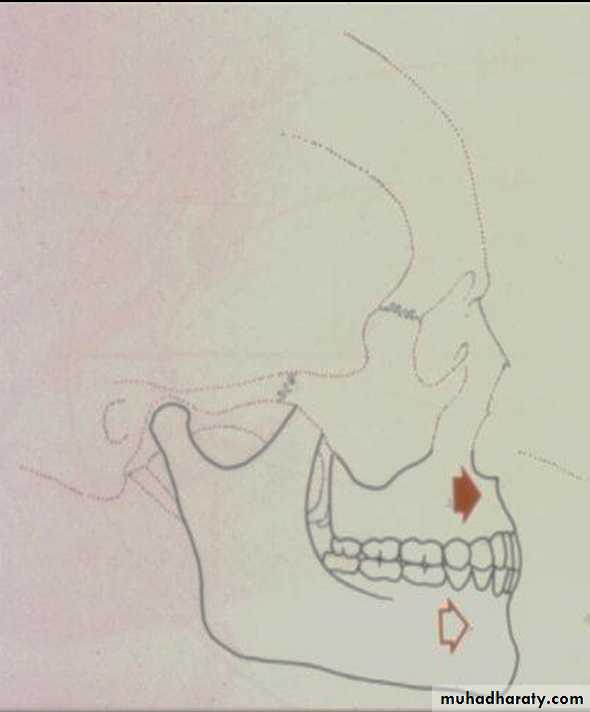 orthognathic surgery