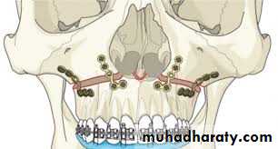 orthognathic surgery