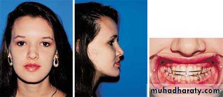orthognathic surgery
