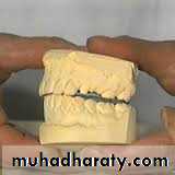 Interocclusal Record