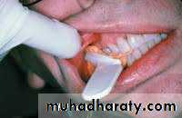 Interocclusal Record