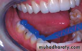 Interocclusal Record