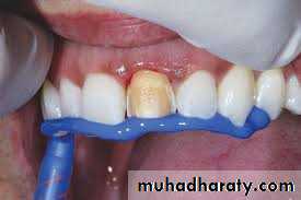 Interocclusal Record