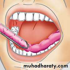 Interocclusal Record