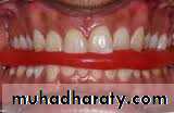 Interocclusal Record