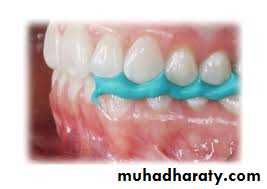 Interocclusal Record