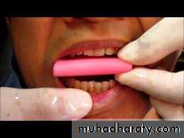 Interocclusal Record