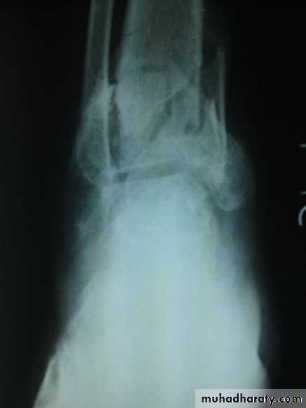 Tibia and fibulae