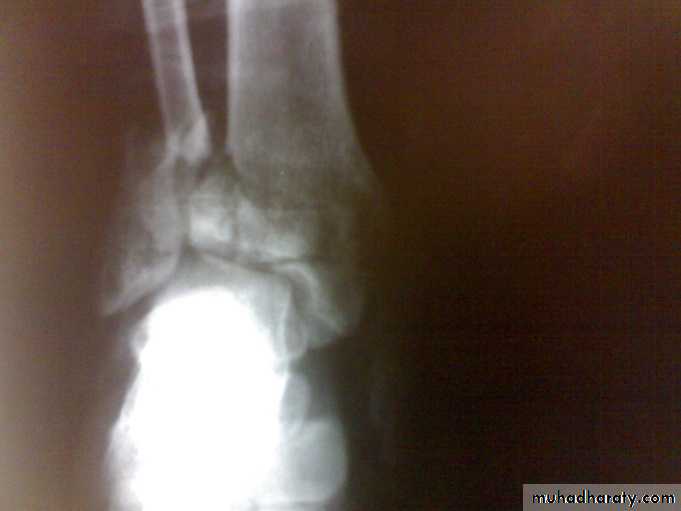 Tibia and fibulae