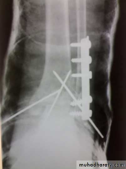 Tibia and fibulae