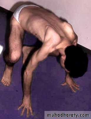 DISEASES OF THE MUSCLES