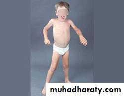 DISEASES OF THE MUSCLES