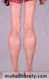 Disease of the muscle