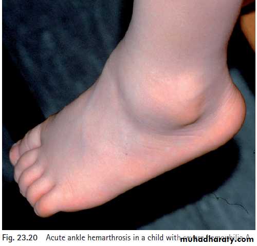 Disorders of Hemostasis