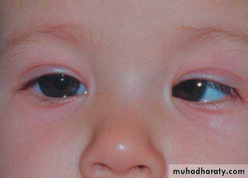 THYROID EYE
