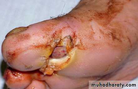 mycobacterium