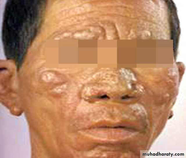 mycobacterium