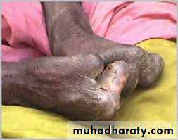mycobacterium