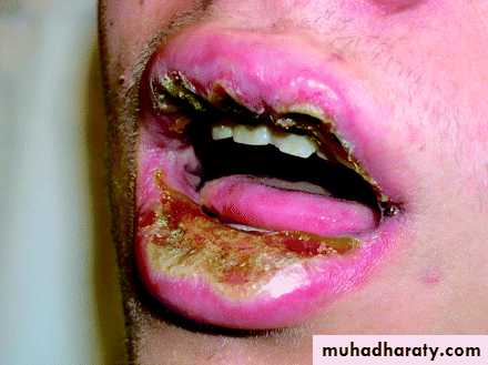 mycobacterium