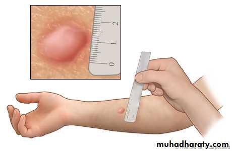 mycobacterium