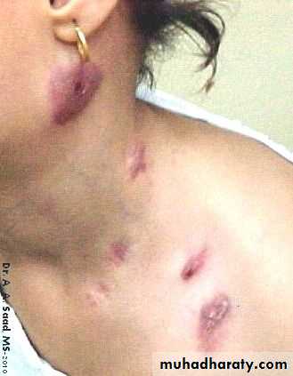 mycobacterium