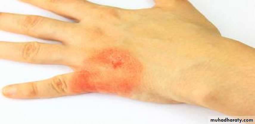 mycobacterium