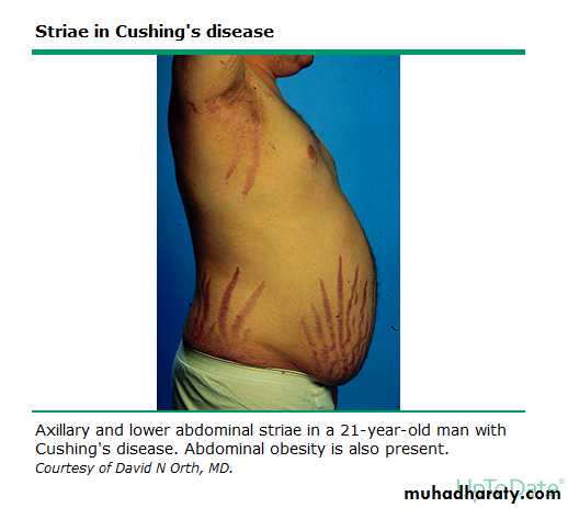 cushing