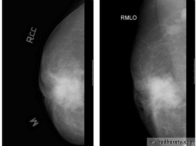 mammogram
