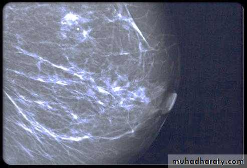 mammogram