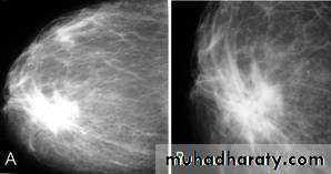 mammogram