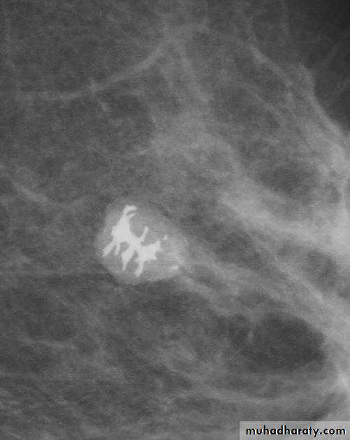 mammogram