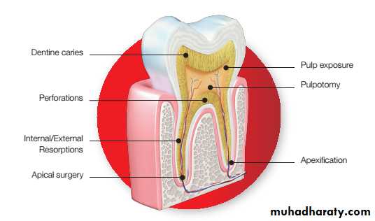 Pulp protection