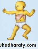 jaundice