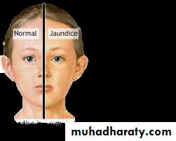 jaundice