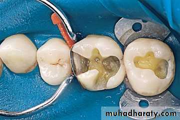 local anesthesia