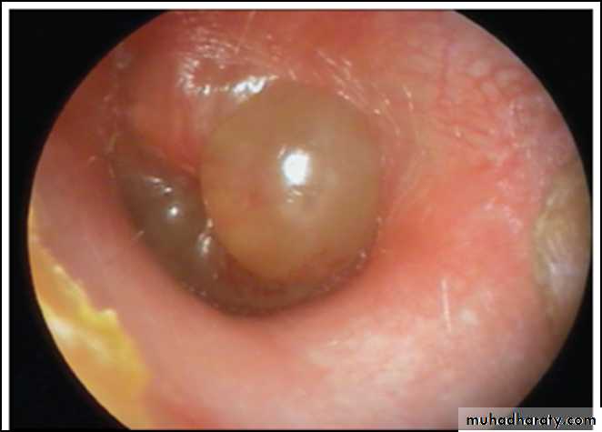 otitis externa