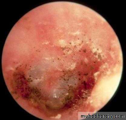 otitis externa