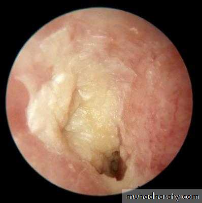 otitis externa