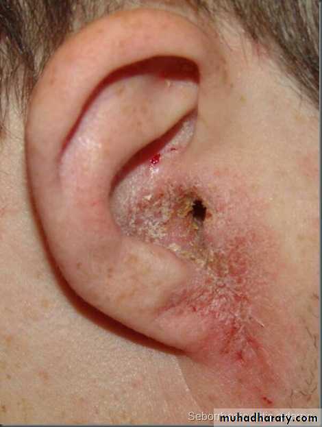 otitis externa