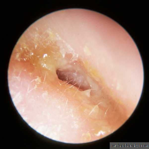 otitis externa