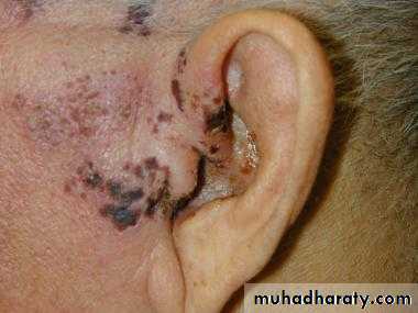 otitis externa