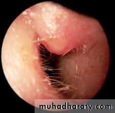 otitis externa