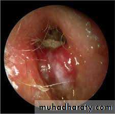 otitis externa