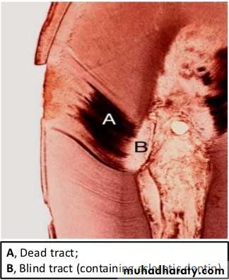 Treatment of deep seated caries