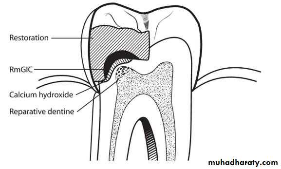 Treatment of deep seated caries